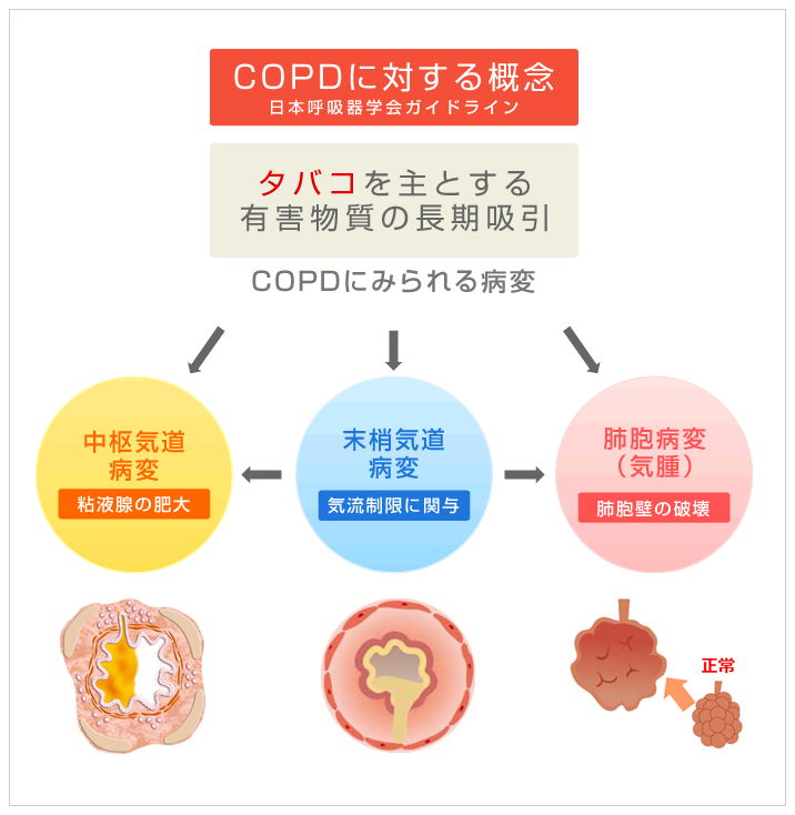 慢性閉塞性肺疾患 Copd とはどんな病気でしょう 医療法人啓生会 やすだ医院は 京都市南区にある呼吸器疾患を専門とする医療機関です