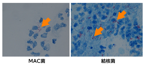 抗 酸 結核 症 と 非 性 は 菌 肺非結核性抗酸菌症｜一般社団法人日本呼吸器学会